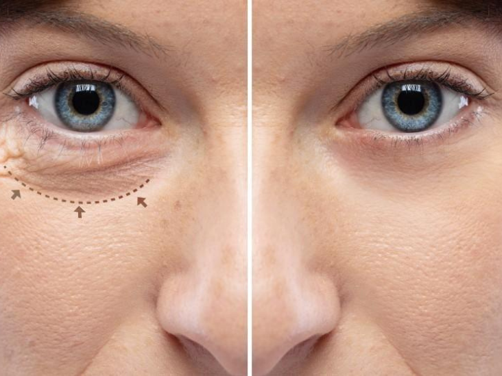 Oculoplastic Surgery