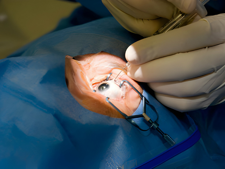 Phacoemulsification Hands-On Training