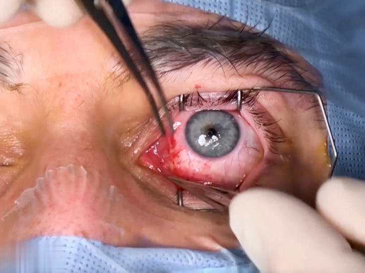 Strabismus Surgery